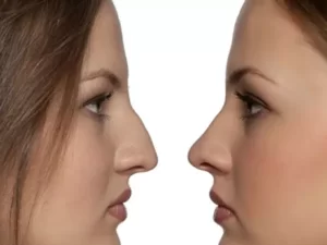 جراحی بینی استخوانی در بجنورد