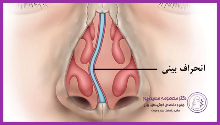 نحوه انجام جراحی شکستگی بینی