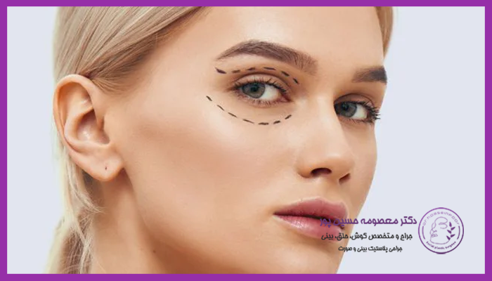 جراحی ترمیمی بلفاروپلاستی برای چه افرادی مناسب است؟