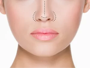 ورم بعد از جراحی بینی