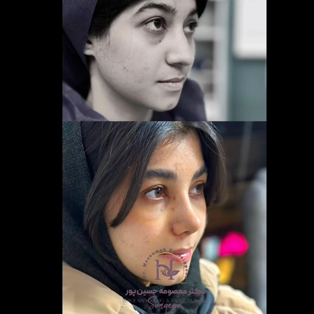 نمونه جراحی بینی غضروفی دکتر معصومه حسین پور