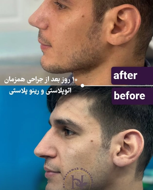 نمونه جراحی زیبایی گوش دکتر معصومه حسین پور