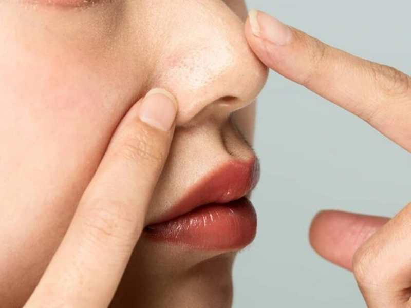 چرب شده پوست بینی بعد از عمل