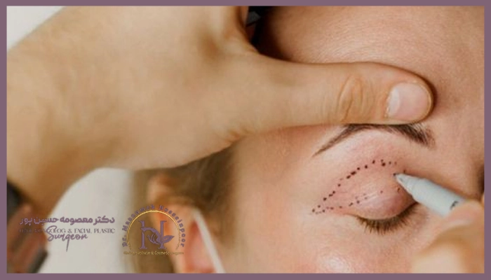 تاثیر سن برروی نتیجه عمل بلفاروپلاستی