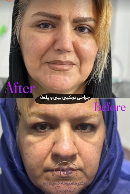 جراحی همزمان بینی و پلک توسط دکتر معصومه حسین پور